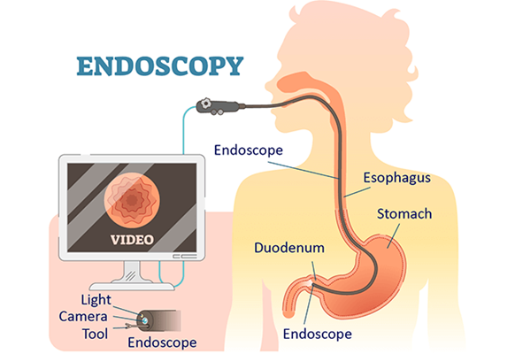 endoscopic procedure illustration.png